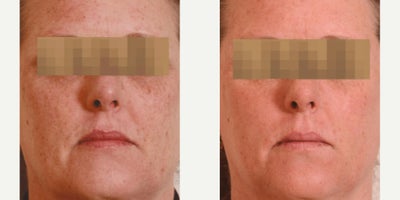 Woman treated with Fractional Laser - Procedures Performed: HALO
