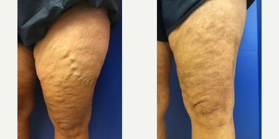 55-64 year old woman treated with Varithena - Before and After Treatment of Varithena