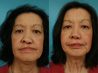 Female treated for adult cleft palate - 
	Cleft lip reconstruction, cleft nasal reconstruction, maxillary surgery
