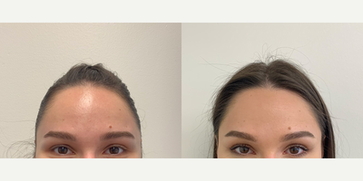Sofwave for a subtle bow lift - Upper face Sofwave therapy to achieve a subtle brow lift.