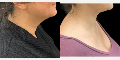 35-44 year old woman treated with Necklift - Necklift