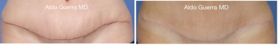 25-34 year old woman treated with Embrace Scar Therapy - Close up photos of a tummy tuck incision treated with embrace Active Scar Defense before and after 8 months post op.