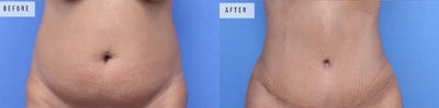 Woman treated with Tummy Tuck, Liposuction - Woman treated with Tummy Tuck, Liposuction
