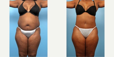 49 year old woman treated with Liposuction - 49 year old woman treated with Tummy Tuck and Liposuction to abdomen, waist, mons area, and lumbar roll. Pre-op, patient had maintained her weight through diet and limited exercise but was still not happy with her shape. She is 5'5 tall and weighed 175 lbs.
