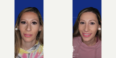 25-34 year old woman treated with Revision Rhinoplasty - 25-34 year old woman treated with Revision Rhinoplasty