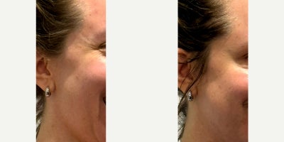 25-34 year old woman treated with Botox - 24 units of Botox to correct crows feet
