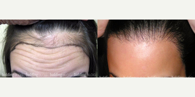 18-24 year old woman treated with Forehead Reduction with Hair Transplant - Forehead Reduction with Hair Transplant to lower and round out the corners.