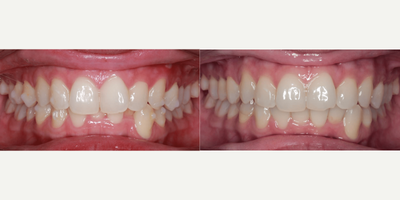 35-44 year old woman treated with Lingual Braces - 35-44 year old woman treated with Lingual Braces.