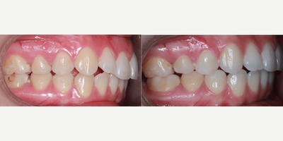 18-24 year old woman treated with Lingual Braces - This adult female patient came to us with mild crowding, a moderate overbite, and moderate overjet. Her lower midline was 2mm to the right of center. Dr. Benson began her treatment with the Carriere Motion Appliance for the first 3 months of her treatment (she had excellent rubber band wear!).