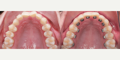 35-44 year old woman treated with Lingual Braces - 35-44 year old woman treated with Lingual Braces.
