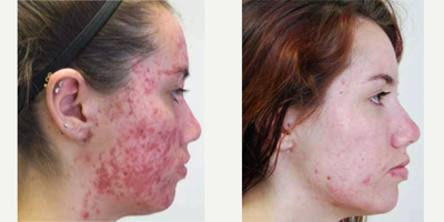 LED Light Therapy for Acne Treatment - This patient received 2 ct. sessions each 20-minute Blue and Red weeks of LED Light Therapy twice a week for 6 weeks, a total of 12 sessions.