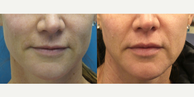 46 year old woman treated with Volbella - This patient wanted a subtle lip enhancement. She was treated with a half syringe of Juvederm Volbella.