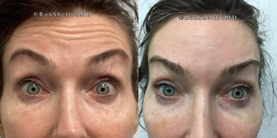 45-54 year old woman treated with Daxxify - 50 year old woman treated with Daxxify on forehead lines,  2 weeks after Daxxify. Forehead smoother and eyebrows lifted when raising and at rest