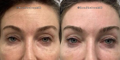 45-54 year old woman treated with Daxxify - 50 year old woman treated with Daxxify on forehead lines,  2 weeks after Daxxify. Forehead smoother and eyebrows lifted when raising and at rest