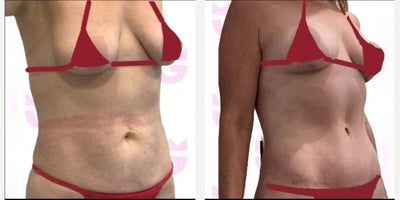 Woman treated with Tummy Tuck - Woman treated with Tummy Tuck.