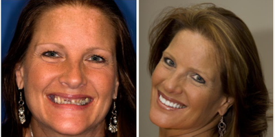 45-54 year old woman treated with Full Mouth Reconstruction - The doctorcrowned 8 teeth, placed #8 Implant with crown, and did cosmetic bondings on the lower anterior teeth. She also has a removable partial on the upper and lower to replace some missing teeth to stabilize her bite.