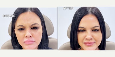 25-34 year old woman treated with Botox - 28 year old woman treated with Botox