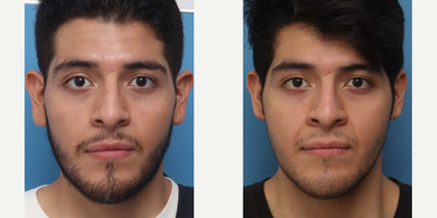 Man treated with Earlobe Repair - Man treated with Earlobe Repair