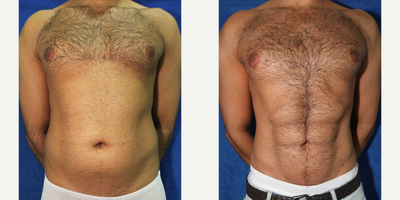 25-34 year old man treated with Abdominal Etching - This patient in his early 30s had poor abdominal definition despite his constant working out. He underwent VASER Hi-Def Abdominal liposuction to remove fat from the rectus abdominis musculature. This leads to a more visible rectus abdominis musculature (or six-pack abs).