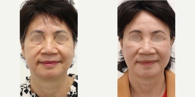 55-64 year old woman treated with Facelift, MACS Facelift, SMAS Facelift - A female patient underwent a facelift procedure in the summertime of 2022 in San Francisco, CA, by Dr. Charles Lee. The patient experienced a successful outcome post-surgery, speaking highly of the meticulous work done by Dr. Lee. The procedure left the patient feeling rejuvenated and satisfied with the natural-looking results. Dr. Lee's expertise and the supportive staff at the clinic contributed to a positive experience for the patient, enhancing her self-confidence and well-being.
