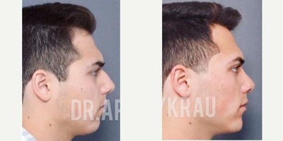18-24 year old man treated with Rhinoplasty - This patient underwent a rhinoplasty with chin augmentation by Dr.AryKrau...Now he has more balance and defined facial features