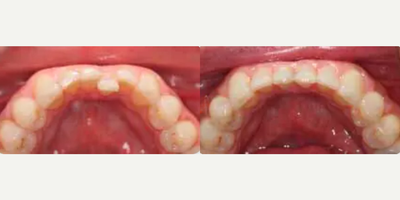 Woman treated with Invisalign - Patient had a chief complaint of a lower tooth on the move. MTM clear aligner treatment was used on the lower teeth to correct the lower crowding in just 3 months!