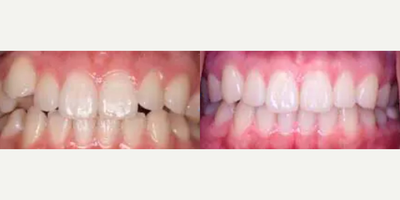22 year old woman treated with Invisalign - 22 year old female patient presented with a chief complaint of a childlike-looking smile and a canine stuck up in the gums. Invisalign treatment was used with Dr. Steven Davidowitz accelerated propel technique and tooth just 10 months to complete.