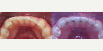 Man treated with Invisalign - Patient complained of relapse from prior orthodontics that he had when younger. Invisalign was used in conjunction with Dr. Steven Davidowitz Accelerated Propel technique and was completed in less than 6 months.