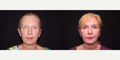 55-64 year old woman treated with ArteFill - 64 year old female received Bellafill to the nasolabial folds and marionettes; photos depict the patient's results 4 months post-treatment.