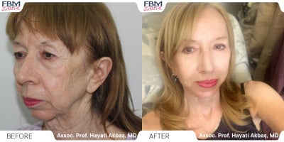 65-74 year old woman treated with Deep Plane Facelift, Neck Lift, Eyelid Surgery, Facial Fat Transfer - 65-74 year old woman treated with Deep Plane Facelift, Neck Lift, Eyelid Surgery, Facial Fat Transfer