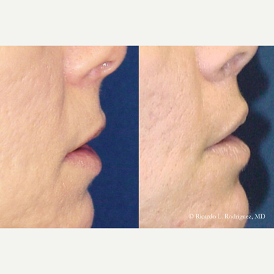 Lip Lift - Lip Lift