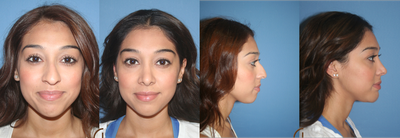 Ethnic Rhinoplasty - 
	Rhinoplasty
