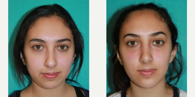 18-24 year old woman treated with Chin Surgery - Rhinoplasty and Chin Augmentation
