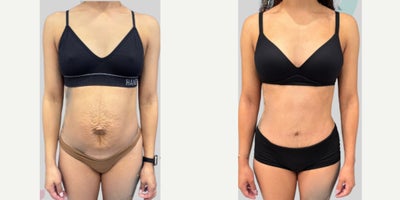25-34 year old woman treated with Tummy Tuck, Diastasis Recti Repair - This beautiful patient presented with severe rectus diastasis following 2 pregnancies, and underwent short-scar Tummy tuck with Liposuction, as well as Diastasis Recti Repair to create a flatter, stronger and more defined abdominal contour.  We also created a small innie belly button with minimal scarring on the outside.The scars will continue to fade over time.