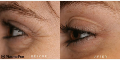 Woman treated with PlasmaPen - Woman treated with PlasmaPen