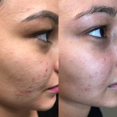 45-54 year old woman treated with DefenAge - Here are two examples of our patients using the Defenage skin care system. These photos were taken 1 week apart! The first photo, the patient is in her mid 20s and the second is in her mid 60s! Defenage is suited to all ages and skin types.
