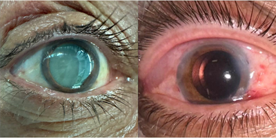 Person treated with Cataract Surgery - When it reaches this advanced level, as in our patients today, vision is no longer possible. However, if there is no additional eye disease, with good surgery, vision begins the next day. I can say that it is one of our most enjoyable surgeries. However, do not wait until this stage, when the risk of complications increases, think about me too.