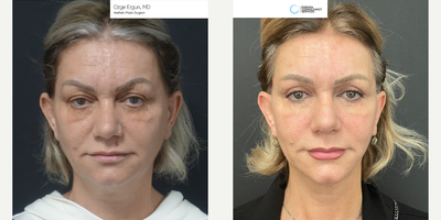 35-44 year old woman treated with Facelift - Facelift
