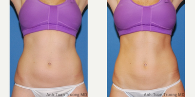 SculpSure - SculpSure