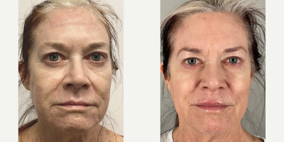 Woman treated with Ellacor - Woman treated with Ellacor