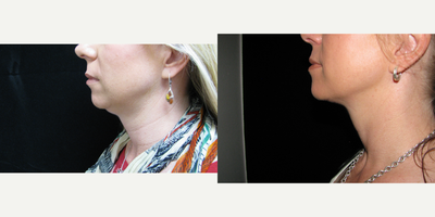1 Kybella treatment followed by Forma RF - One Kybella treatment was followed by 3 Forma RF treatments to tighten skin after fat was dissolved.