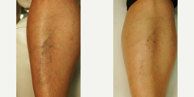 Pain Free Spider Veins Sclerotherapy with Asclera - Pain free sclerotherapy with the newest injection product Asclera for spider veins.  Look at what one treatment can do. Spider vein removal after 1 vein injection.