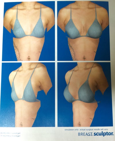 22 Years Old, No Kids, 34A to 34DD, 450cc Silicone Implants 