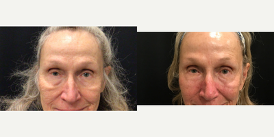 69 year old woman treated with Agnes RF to under eyes - 69 year old woman treated with Agnes RF to under eyes