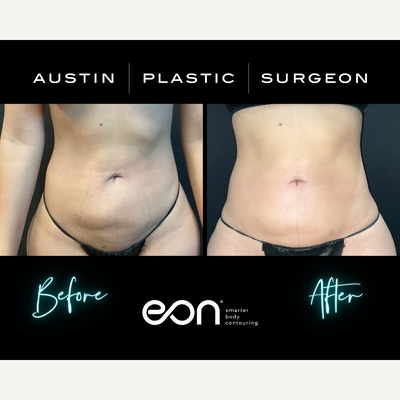 25-34 year old woman treated with Eon - Eon Treatment in Austin TX