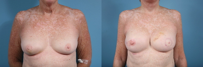 Breast Reconstruction - Breast reconstruction patient