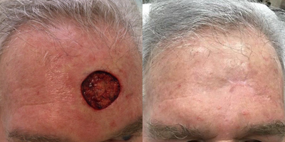 65-74 year old man treated with Cyst Removal - 67 YO after excision of melanoma and partial purse string closure with continued healing and wound care.