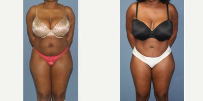 25-34 year old woman treated with Tummy Tuck - Full tummy tuck, muscle repair, umbilical hernia repair