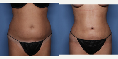 25-34 year old woman treated with BodyTite - 32 y/o female shown 6 weeks after BodyTite liposuction of her abdomen and regular liposuction of her flanks and bra rolls with 3.75 L removed.
