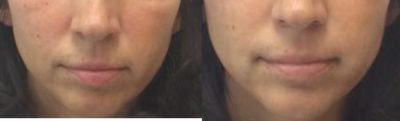 35-44 year old woman treated with Restylane - This woman had her nasolabial (cheek) folds injected with filler (restylane).Subtle but immediate results!